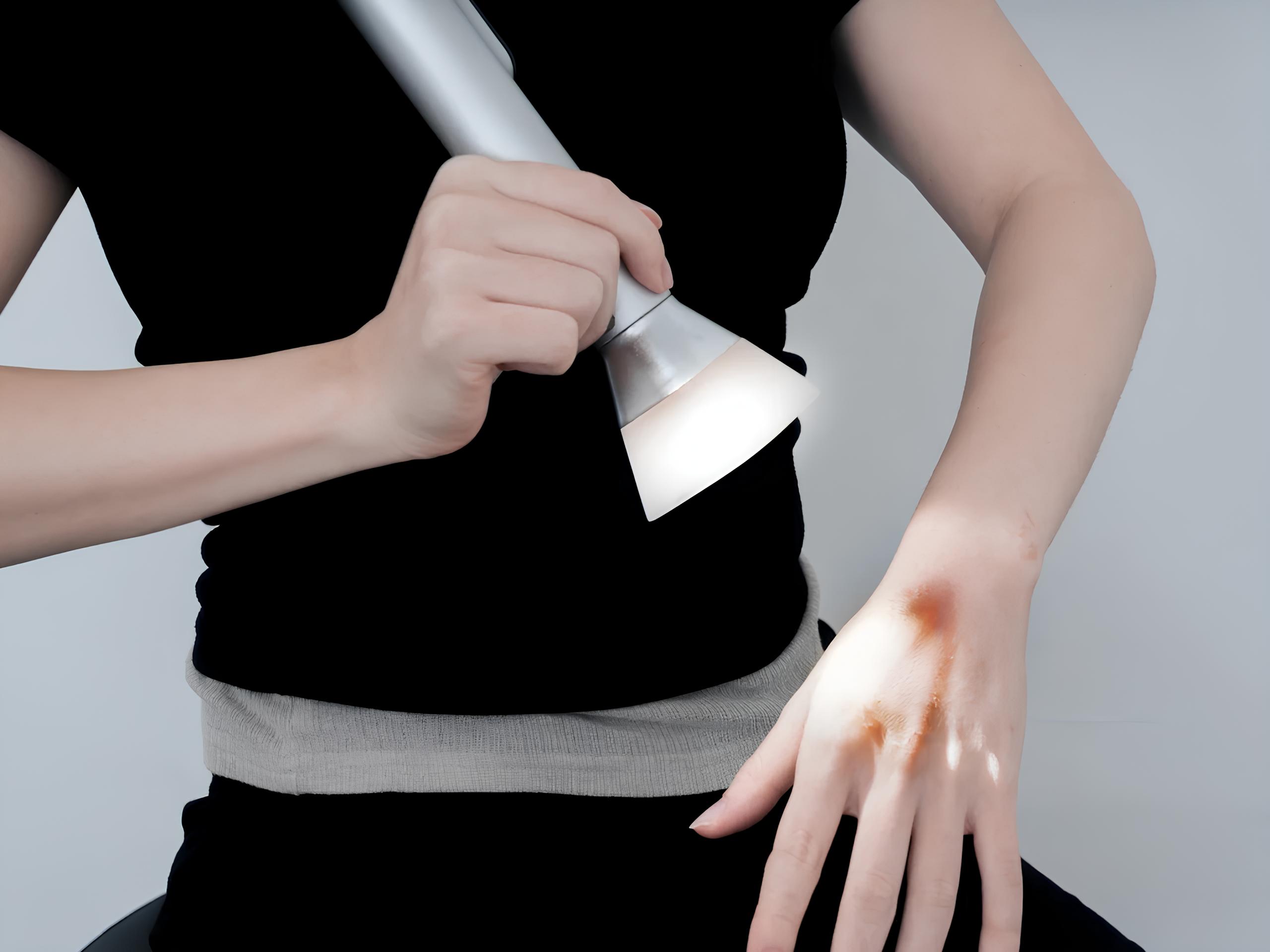 ii-izmenit-lechenie-ozhogov